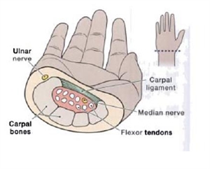 Carpal Tunnel Syndrome - CTS