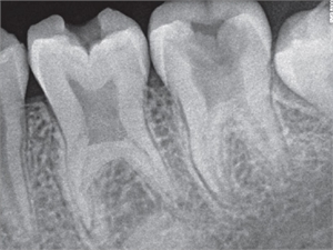 X-ray of taurodontic teeth