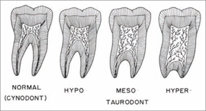 Taurodontism can be divided into several groups - cynodonts (normal teeth), hypotaurodonts, mesotaurodonts and hypertaurodonts.