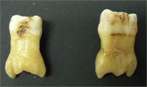 Extracted taurodontic teeth