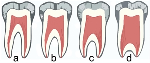 Taurodonts - teeth with taurodontism