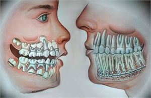 Mixed dentition and adult teeth