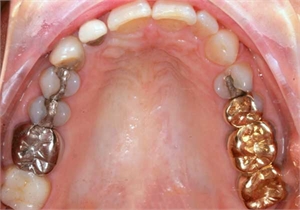 Oral Galvanism caused by different metals in mouth