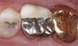 Different metals in mouth cause dental galvanism.