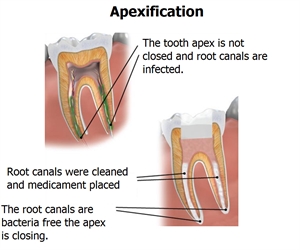 Apexification promotes the apex closure and is done when the tooth pulp is necrotic.