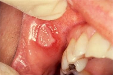 Major aphthous ulcers