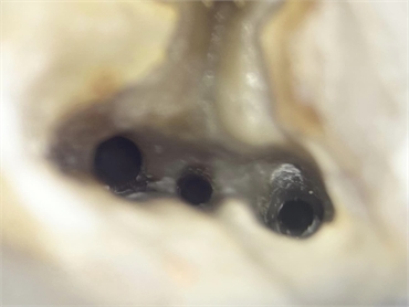 Tooth root canal orifices