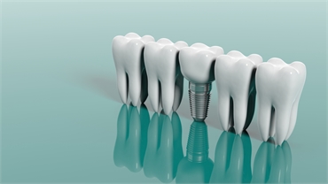A Look At 5 Benefits Of Dental Implants In Miami