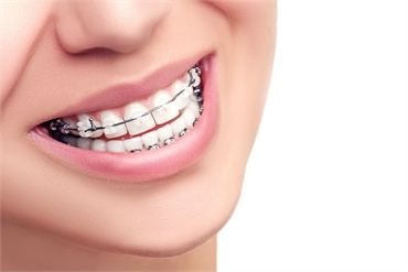 4 Common Types Of  The Cheapest Braces In Miami