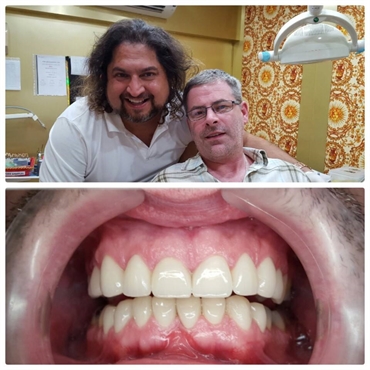 Smile Makeover session with our patient