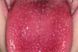 Strawberry tongue is sometimes also referred to as ‘raspberry tongue’
