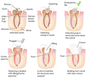 There are two ways to treat an abscess- remove the tooth or perform a root canal treatment. The endodontic therapy procedure removes the pathogenic bacteria from the root canal system and promotes periapical tissue healing.