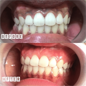 Gum whitening is a trendy dental procedure that lightens your gums.