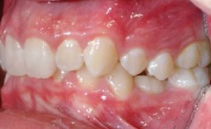 Ankylosed Tooth in the Mouth