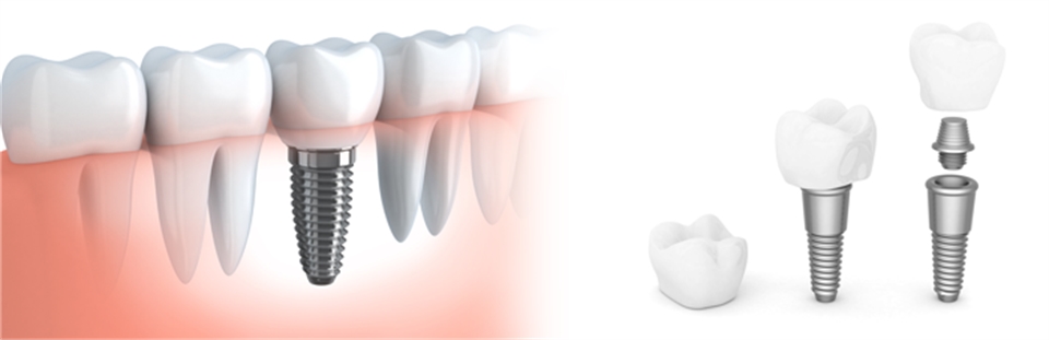 Dental Implant in delhi