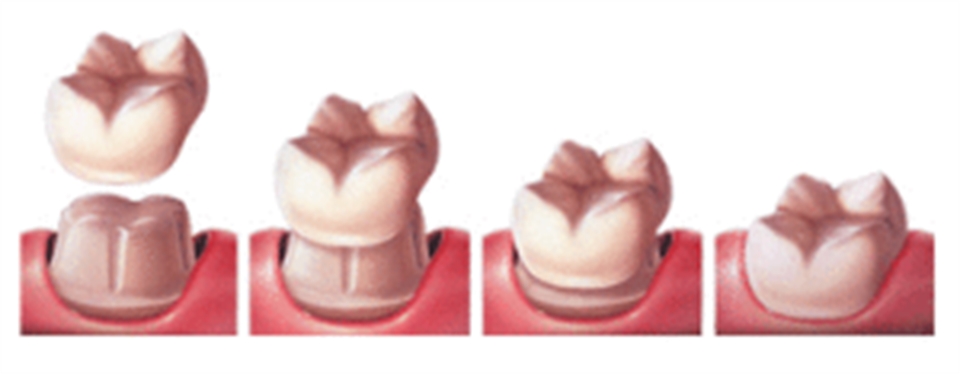 Dental Crowns Bountiful- naperville cosmetic dentistry