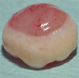 Undeveloped wisdom tooth without roots removed during germectomy procedure.