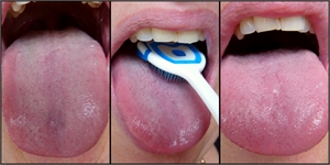 Brushing tongue with a tongue scraper. Before and after picture.
