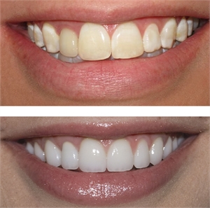 Teeth whitening - post whitening advice