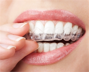 Home Teeth Whitening with Special Trays
