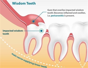 Pericoronitis is a dental condition in which the soft tissues around the erupting crown are swollen, red and inflamed.