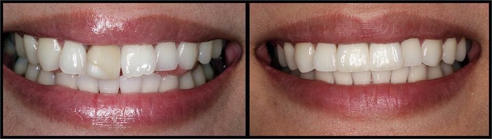 Implant And Crowns Before And After 