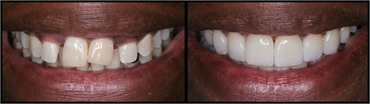 Gum Lift Veneers Before And After