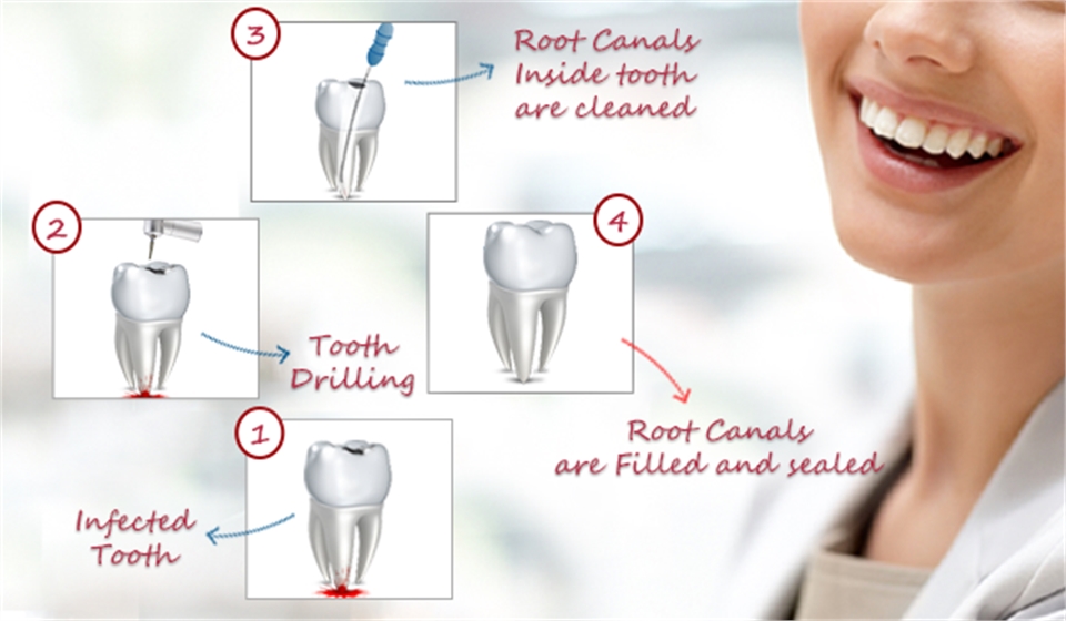 Root Canal Treatment Richmond