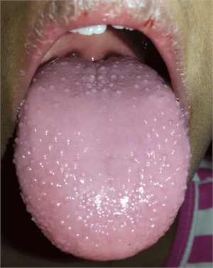 Patient with 'strawberry tongue'