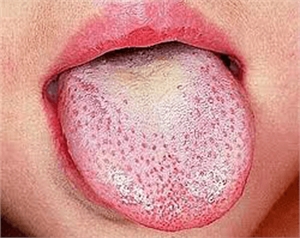 Scarlet fever causes enlargement of the fungiform papillae, or so called strawberry tongue