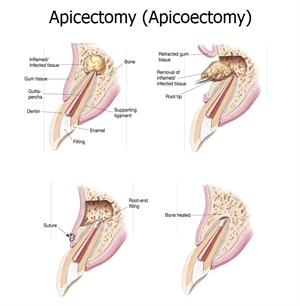 Apicectomy, also known as apicoectomy, is a minor surgical procedure of chopping off the root of the tooth and sealing it from the top.