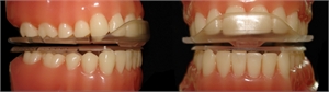 Dawson occlusal B-splint reduces muscle tension and repositions the mandibular condyle in the TMJ