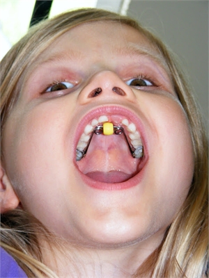 Bluegrass Ortho Appliance is used for overcoming thumb sucking and tongue thrusting in children