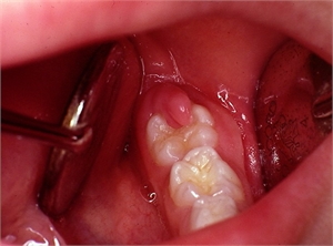 Operculum is the flap of gum tissue that covers the tooth