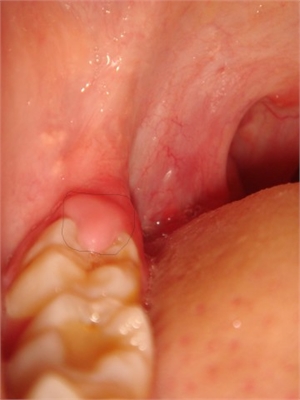 Operculum - gum mucosa over an unerupted tooth
