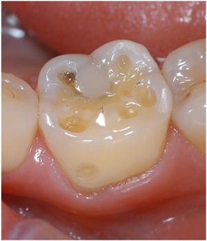 What are wear facets on teeth?