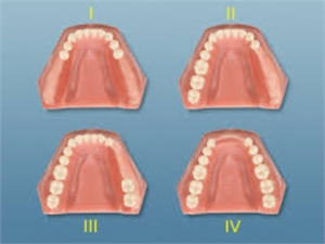 Kennedy classification in dentistry - 4 types of edentulous jaws used to plan the design for partial dentures