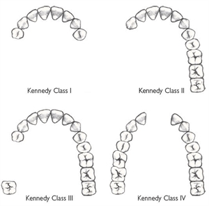 Kennedy classification is divided into 4 groups and is used to plan the partial dentures and the retention elements