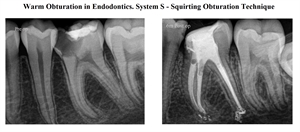 System S - Squirting Obturation Technique in Endodontics