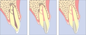 The squirting obturation technique allows the heated guttapercha to flow into the lateral canals of the root canal system and provide a good seal.