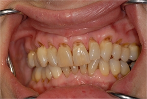 Teeth Abrasion