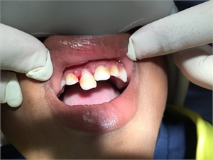 Lateral luxation on upper incisor tooth - socket is broken and the incisor tooth is dislocated palatally