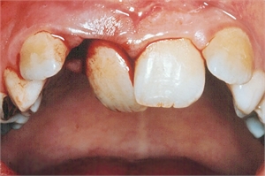 Tooth lateral luxation dental injury