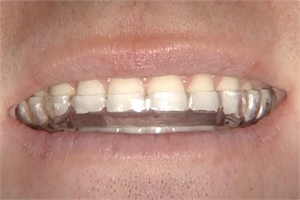 Dental night guards prevent wearing down the occlusal surfaces of the teeth