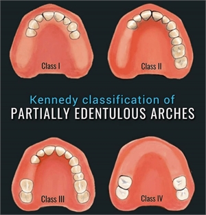 Kennedy Classification of partially edentulous dental arches