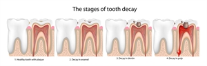 stages of tooth decay. Image  credit : www.ligockidentalgroup.com