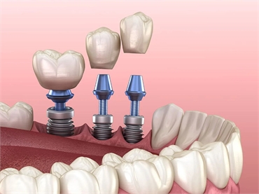 The Complete Guide to Dental Implants Your Comprehensive Overview