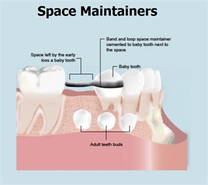 Space maintainers in dentistry