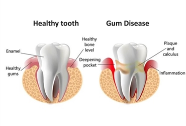 Exploring the Causes and Solutions of Gum Disease