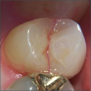This premolar has a VRF (vertical root fracture). In the mouth this appears as a bleeding fracture like going from the mesial to the distal surface of the tooth.